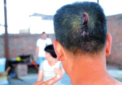 崔先生頭部受傷。京華時(shí)報(bào)記者趙思衡攝/視頻