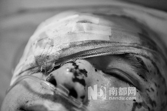 李建新頭部還有被潑硫酸的痕跡，醫(yī)生說被砍傷的右眼已經(jīng)失明。 南都記者 田飛 攝