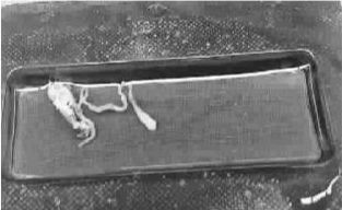 小孩腦部發(fā)現(xiàn)的白色條狀蟲(chóng)體 小孩腦部發(fā)現(xiàn)的白色條狀蟲(chóng)體